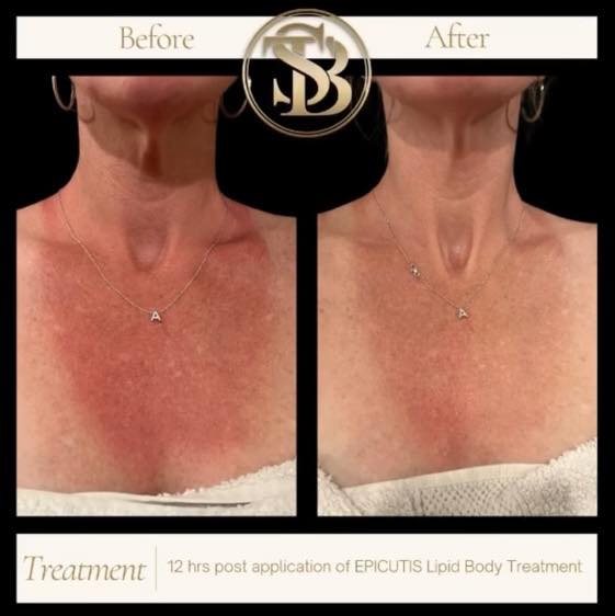 Lipid Body Treatment: Epicutis